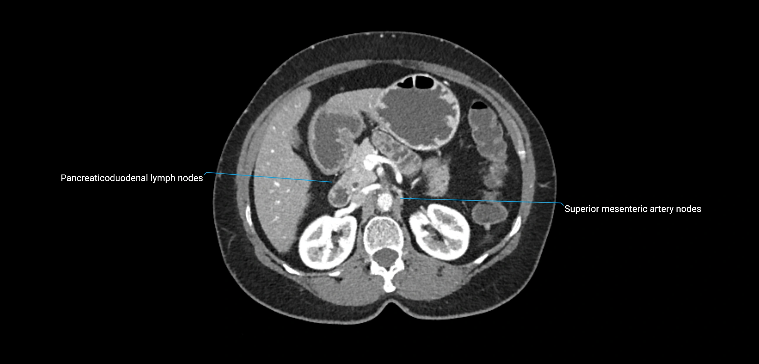 CT ct abdominal lymph nodes  axial cross sectional anatomy  enchanced radiology image -img-00002-00163.webp